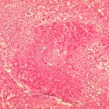 bruceloza-microscopie Microscopie: Examen histopatologic al unui tesut infectat cu Brucella suis