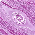 trichinella